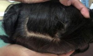 Avani Mirage Hair Patch - Revolutionizing Hair Loss Solutions for Men